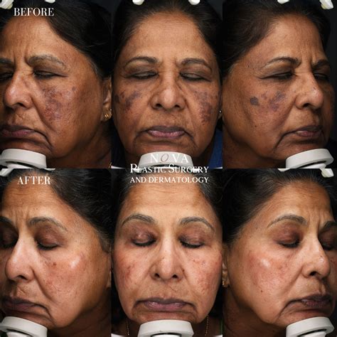 Plastic Surgery and Laser Before & After Photos .